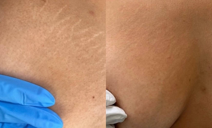 Image 5: Inkless Paramedical Tattoo for Stretch Marks and Scars