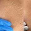 Image 5: Inkless Paramedical Tattoo for Stretch Marks and Scars