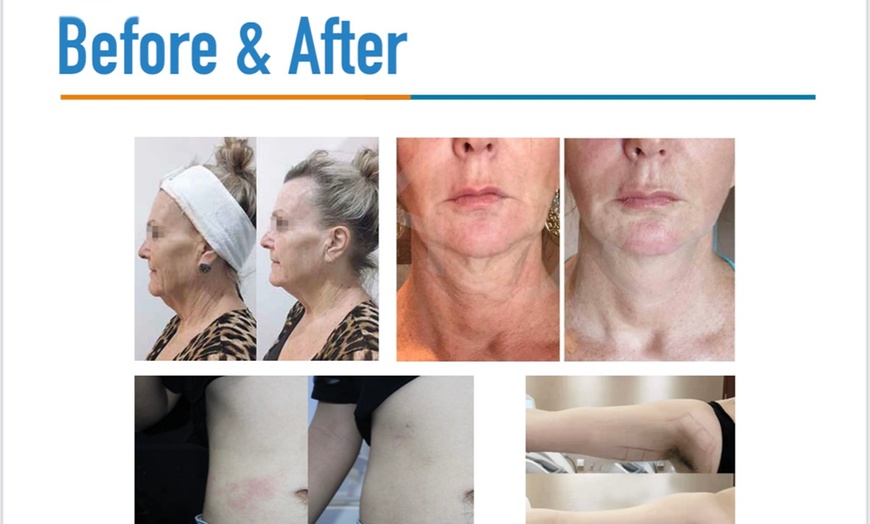 Image 2: HiFu Ultrasound Facial & 90 Minute Facial Experience