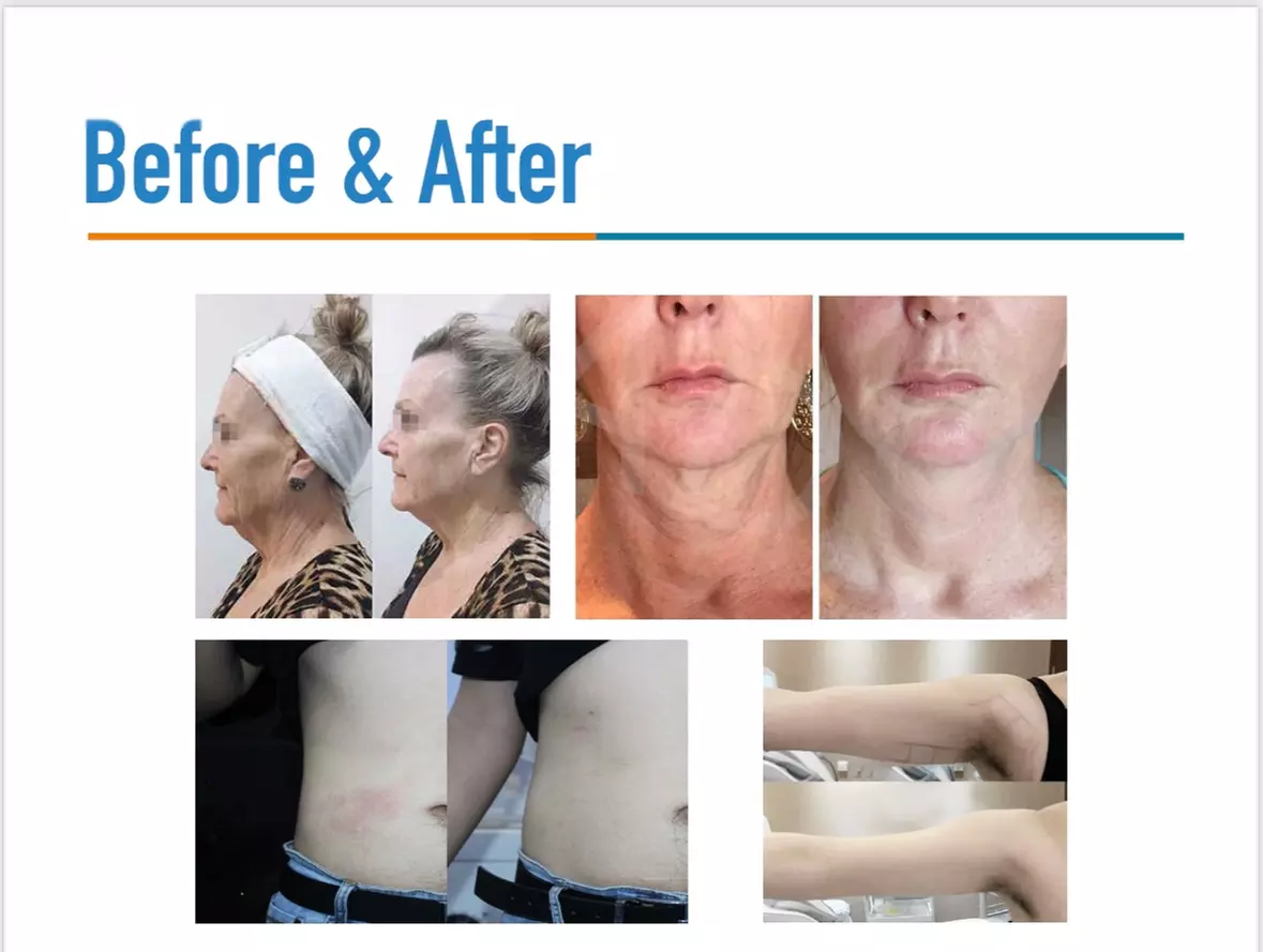Up to 64% Off on Facial - Pore Care at Geca Aesthetics