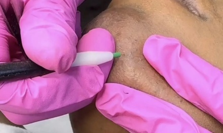 45 Minutes Facial Hair Electrolysis Session - Beautiful Creations Studio