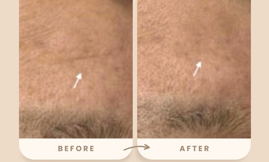 Image 5: Reverse Ageing & Repair Scars: Sylfirm X (One, Two, or Three Sessions)