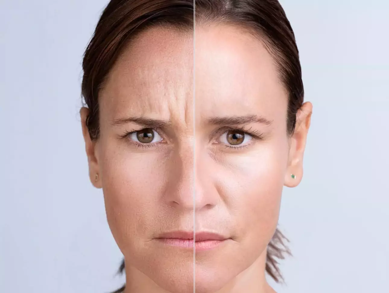 Up to 42% Off on Injection - Xeomin at AB Botox Queen - Second Medium