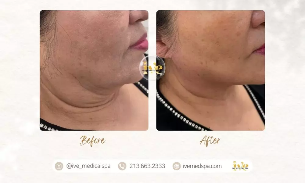 PDO or PCL Thread Lift Session: Jawline, Neck with Optional Nose, Face