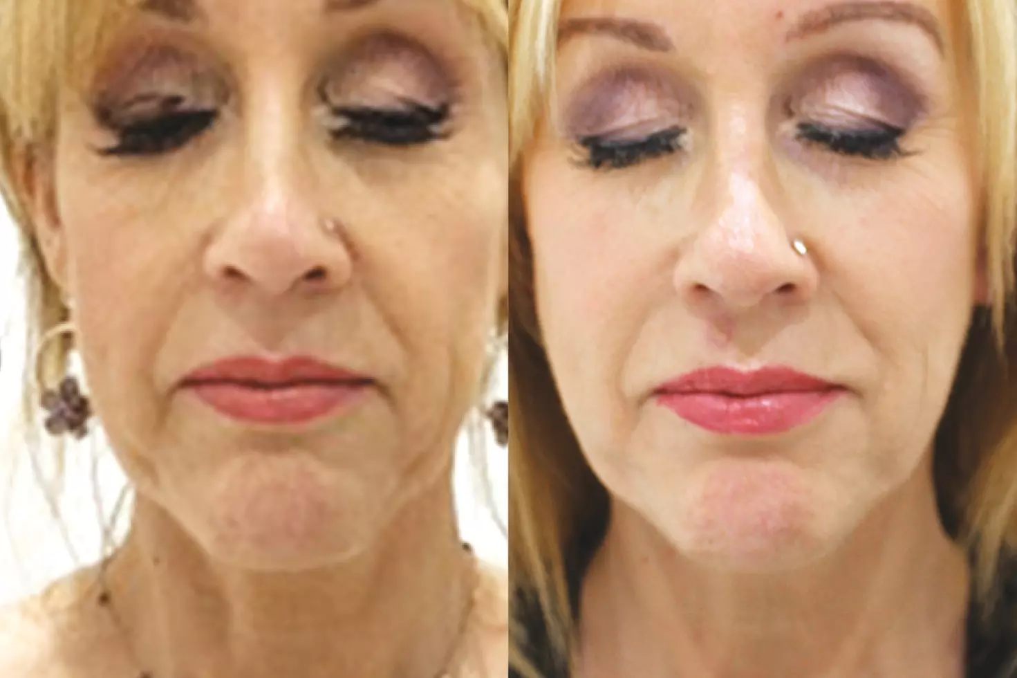 HiFu Treatments for Full Face and/or Neck with Jowls and Jawline