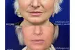 Half Syringe or 1ml RHA Dermal Filler for a Youthful Look at ArtfulSurgery (Up to 35% Off) - Second Medium