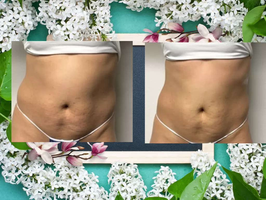 Cavitation with Laser Lipo , Fat Burn + BEMS or Bipolar RF Lymphatic