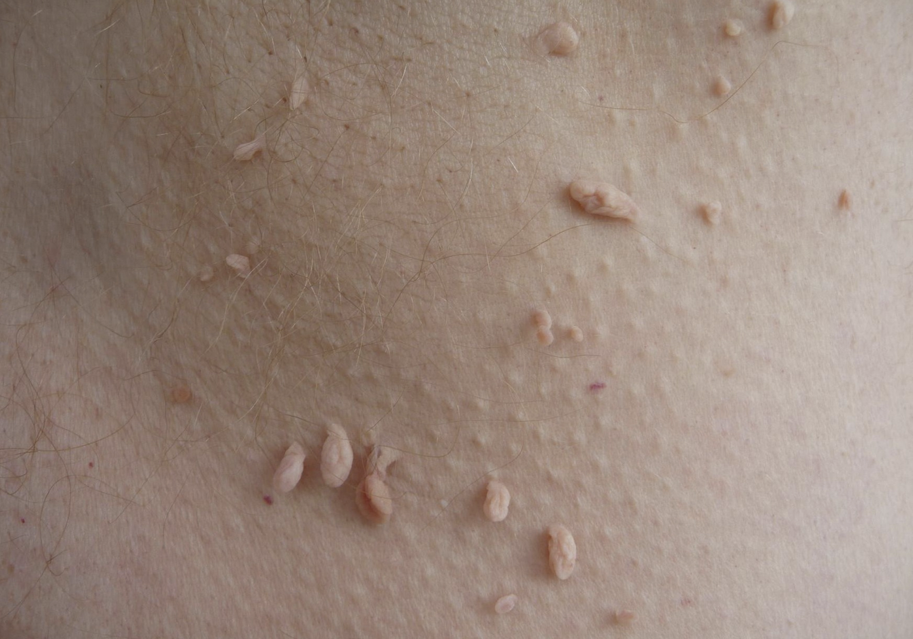 Remove Up to Ten Skin Tags with A Non-Invasive Treatment at DaVída Medical and Aesthetics Offers, Up to 30% Off - Primary Image