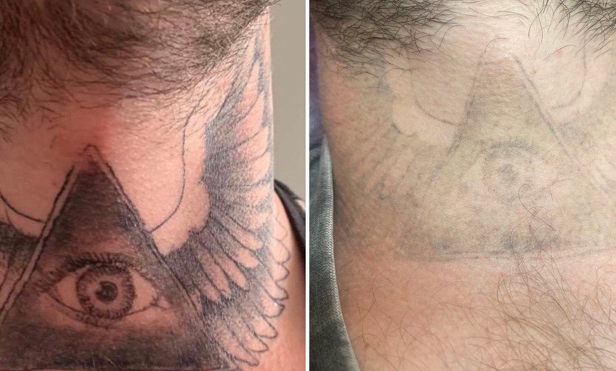 Image 2: Laserowe usuwanie tatuażu lub makijażu permanentnego brwi