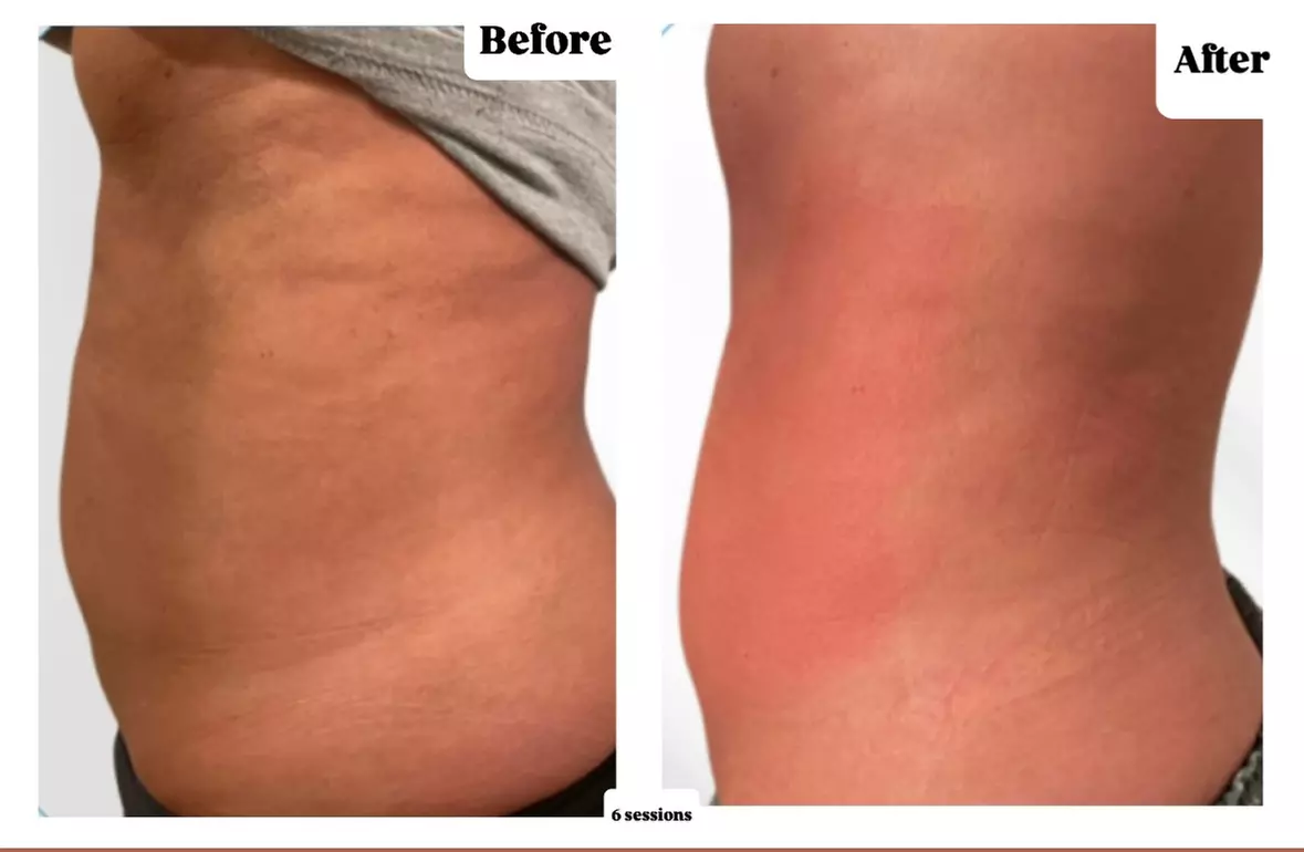 Achieve Body Goals: Cryotherapy Session