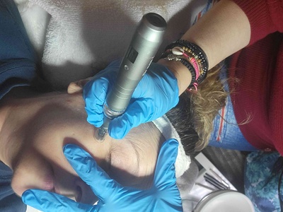 One Anti-Aging Micro-Needling Treatment - Transdermal Aesthetics