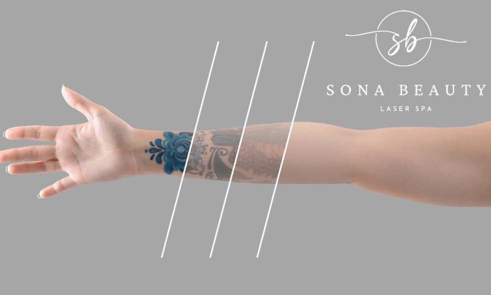 Safe and Effective Tattoo Removal Plan with FDA-approved Laser Technology at Sona Beauty (Up to 64% Off)