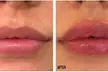 Smooth Out Fine Lines with 20 Units of Botox or 0.5 or 1 ml Syringe of Juvéderm (Up to 62% Off) - Second Medium