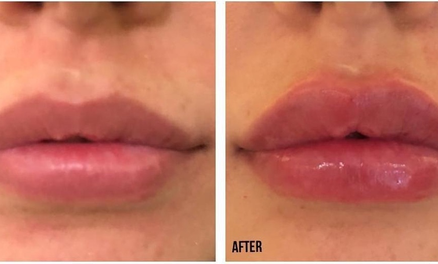 Image 5: Smooth Out Fine Lines with Botox or Juvéderm (Up to 62% Off)