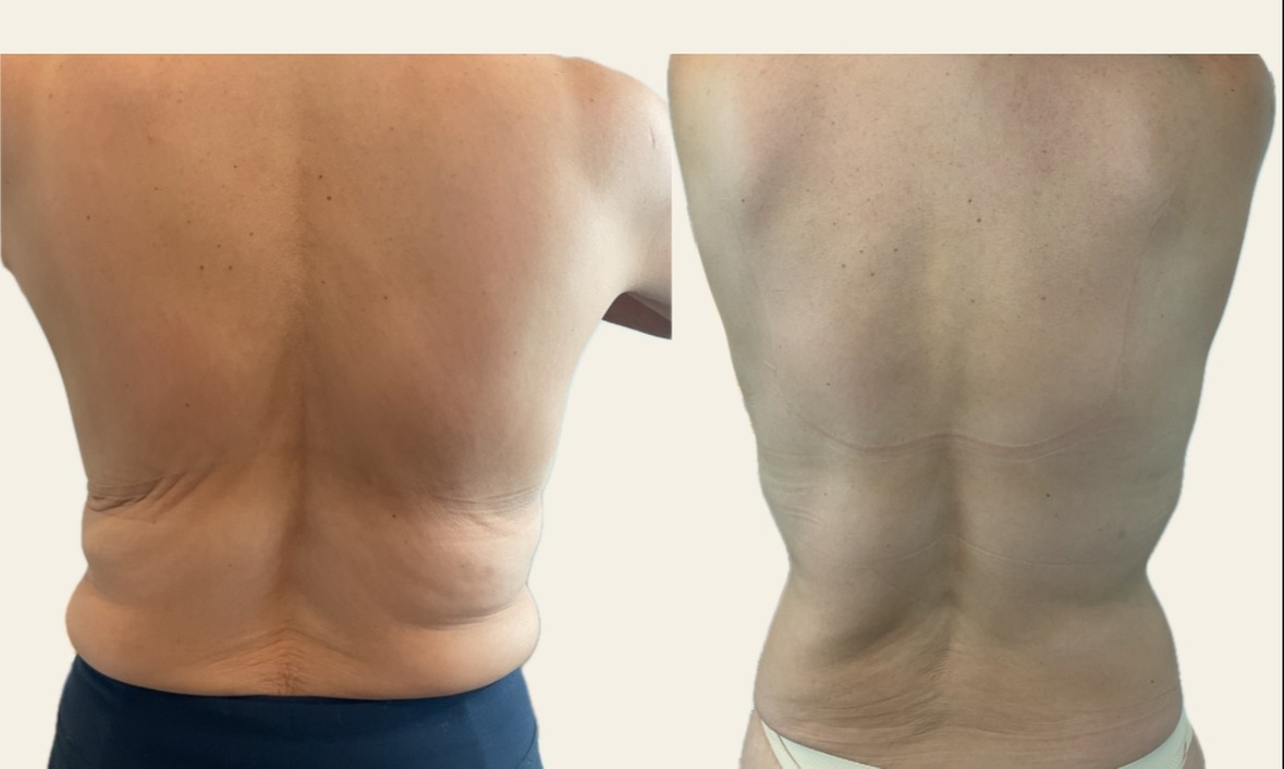 Up to 72% Off on Fat Reduction - Non-Branded at Renew Contouring