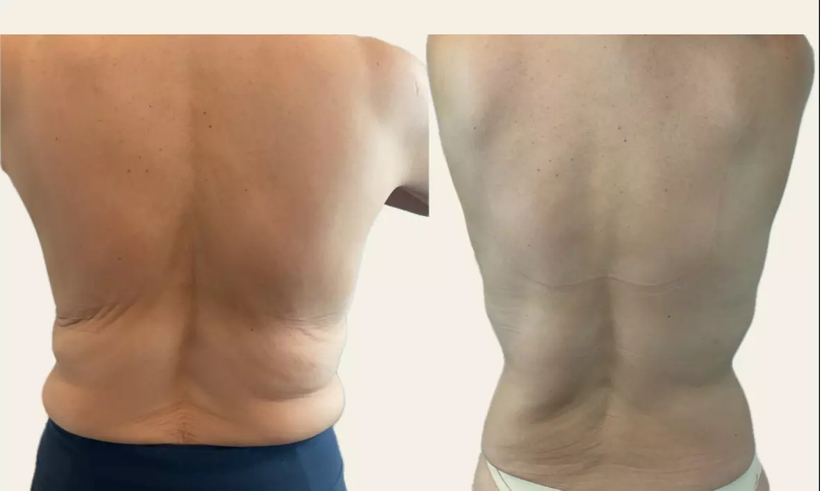 Up to 90% Off on Fat Reduction - Non-Branded at Renew Contouring