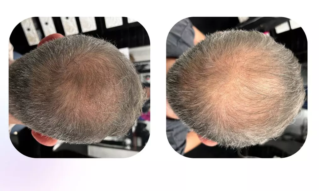 Summer Ready 360 Offers ProCell Hair Regrowth & Scalp Therapy Saving Package (Up to 30% Off) - Primary Image