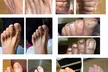 Get Medical Pedicure, Corn and Callus, Ingrown Toenails, Moisturizer - Up to 30% Off - Second Medium