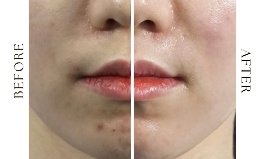 Image 2: Refresh w/ a Korean LHA PEEL for Face or with Neck