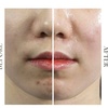 Image 2: Refresh w/ a Korean LHA PEEL for Face or with Neck
