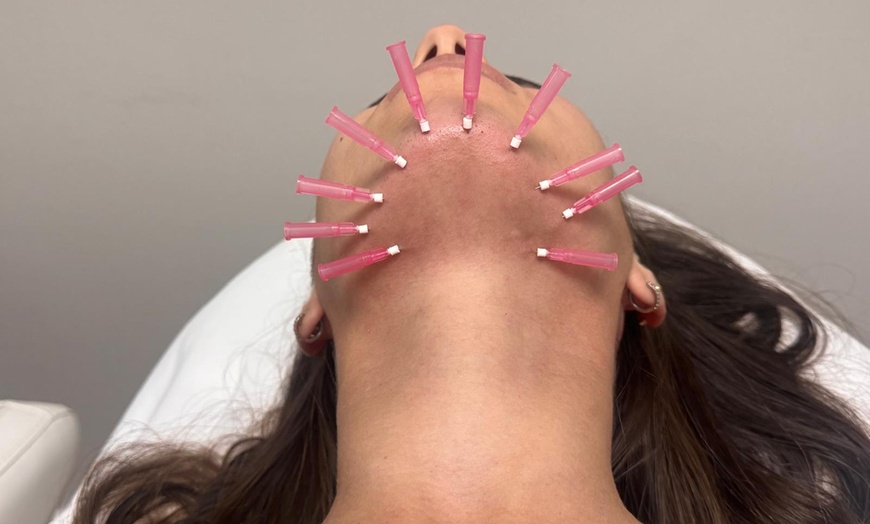 Image 2: Smooth Lines & Redefine Contours with Non-Surgical PDO Thread Lift