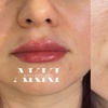 Image 1: Half Or One Full Syringe of Revanesse Versa for Lip Enhancements