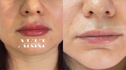 Half Syringe of Revanesse Versa for Lips - AK Medical Spa