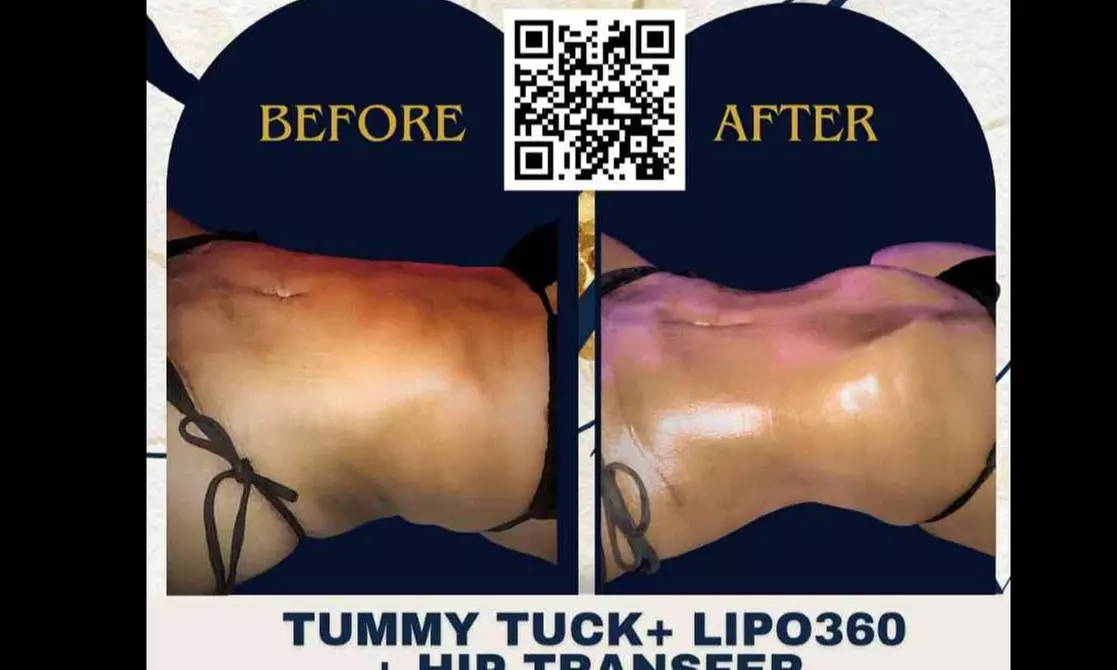 Cosmetic Surgery Aftercare 1 2 Or 3 Packs of 30-Min Recovery Treatment