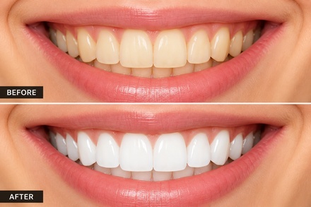Dental Teeth Whitening Treatment - Exclusive Dental Care Group Inc
