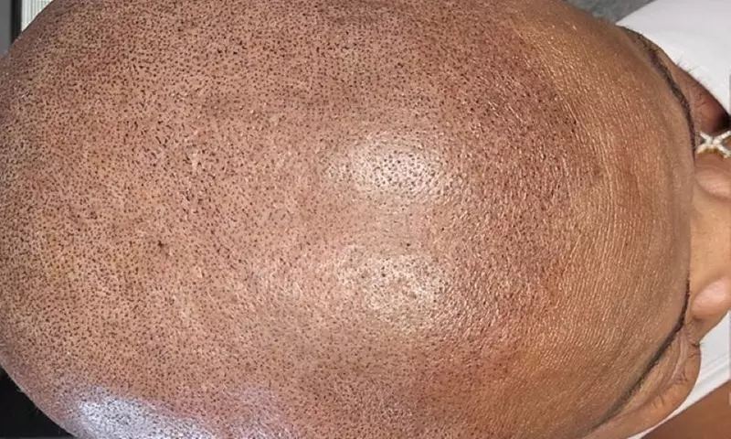 Scalp Micropigmentation for Specific or Partial Area or Full Head at HerCrown SMP Studio (Up to 44% Off) - Image 2