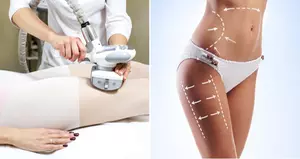 Achieve Body Goals with One or Three Sessions of Endermologie Body Shaping and Firming Treatment at Be In Shape