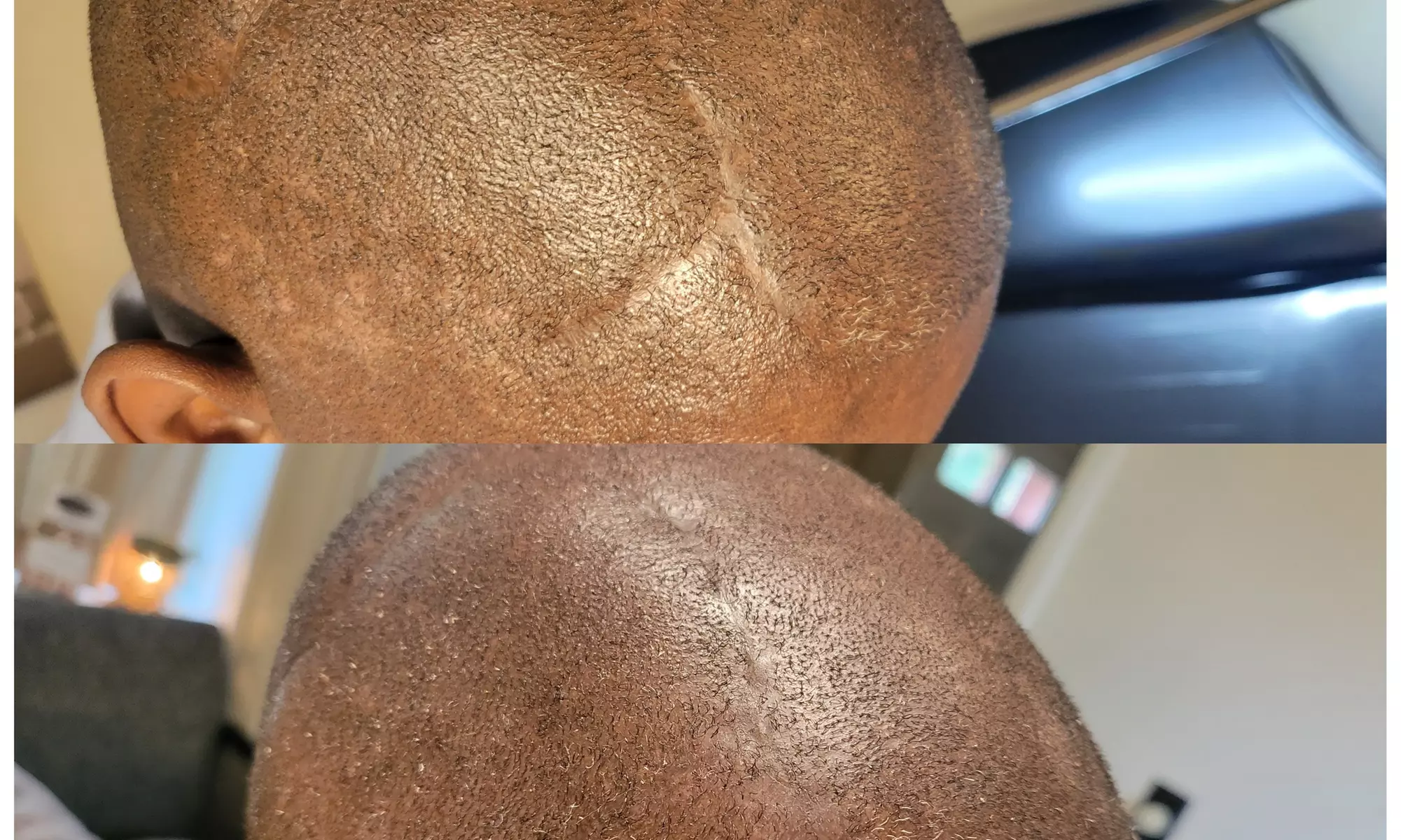 Up to 50% Off on Men and Women's Scalp Micropigmentation