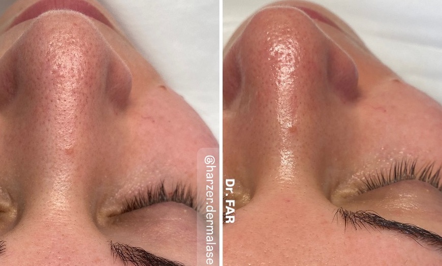 Image 3: Enzym-Hauterneuerung & Serum-Therapie, optional mit Microneedling