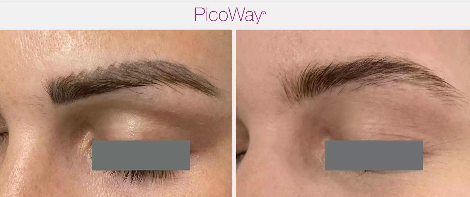 Laser Tattoo & Brow Removal for All Sizes and Skin Types