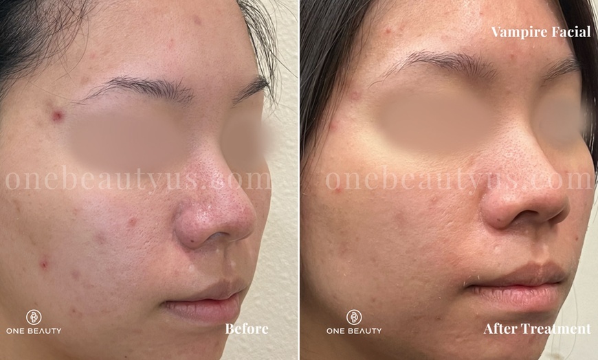 Image 3: Up to 82% Off on Microneedling at One Beauty Aesthetics