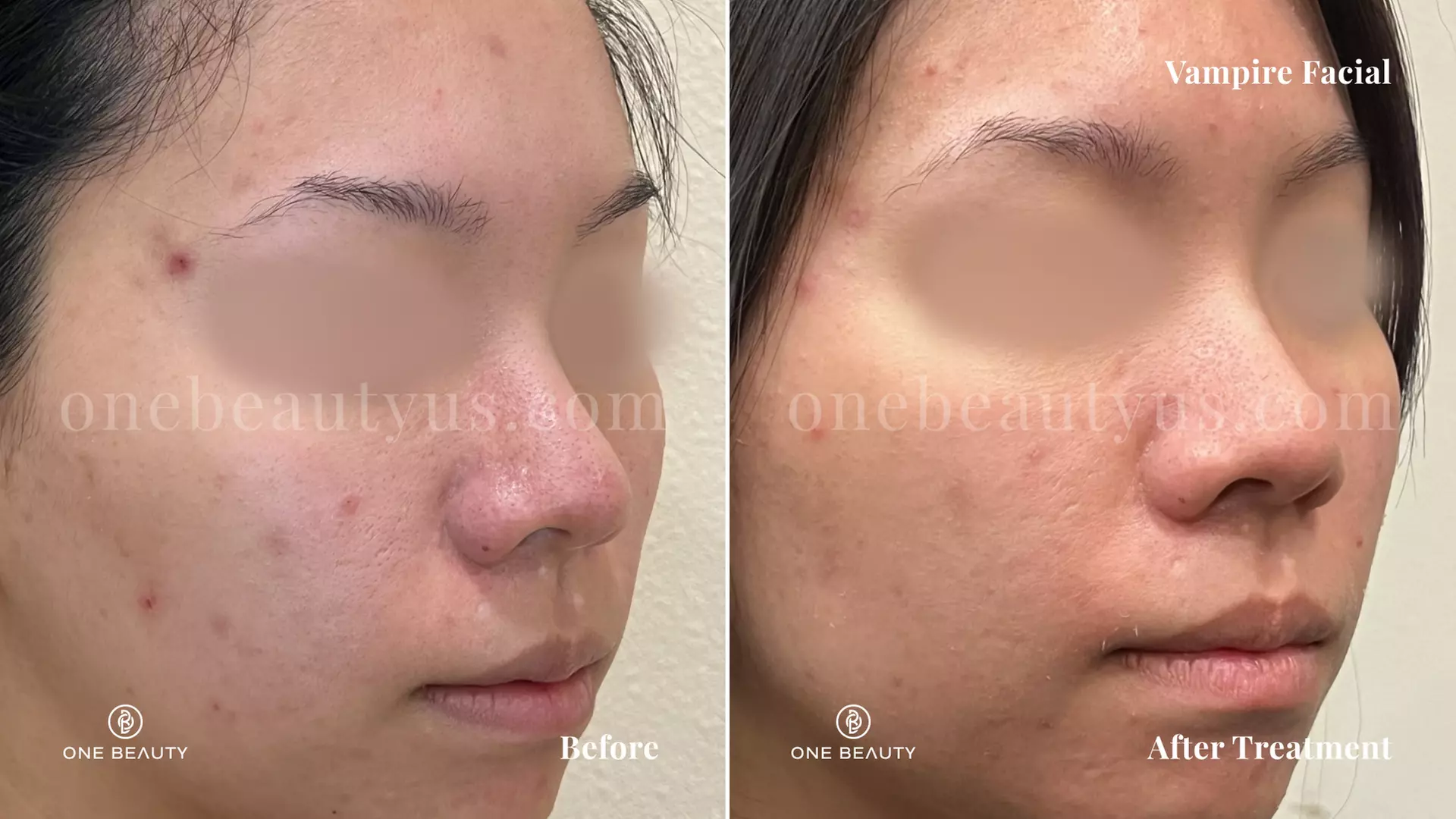 Up to 80% Off on Microneedling at One Beauty Aesthetics - Second Medium