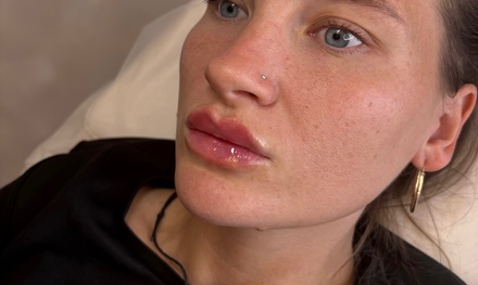 Up to 1ML lip filler with consultation - Clinic nyx mk