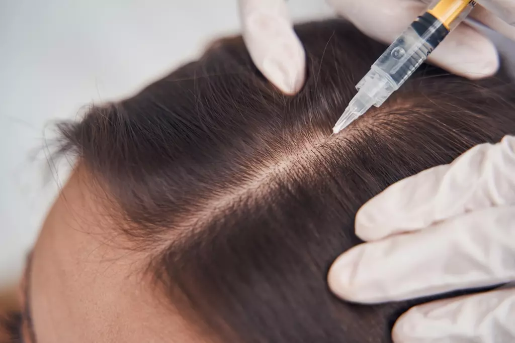 Up to 55% Off on Hair Restoration - Non-Surgical at MycroAesthetics