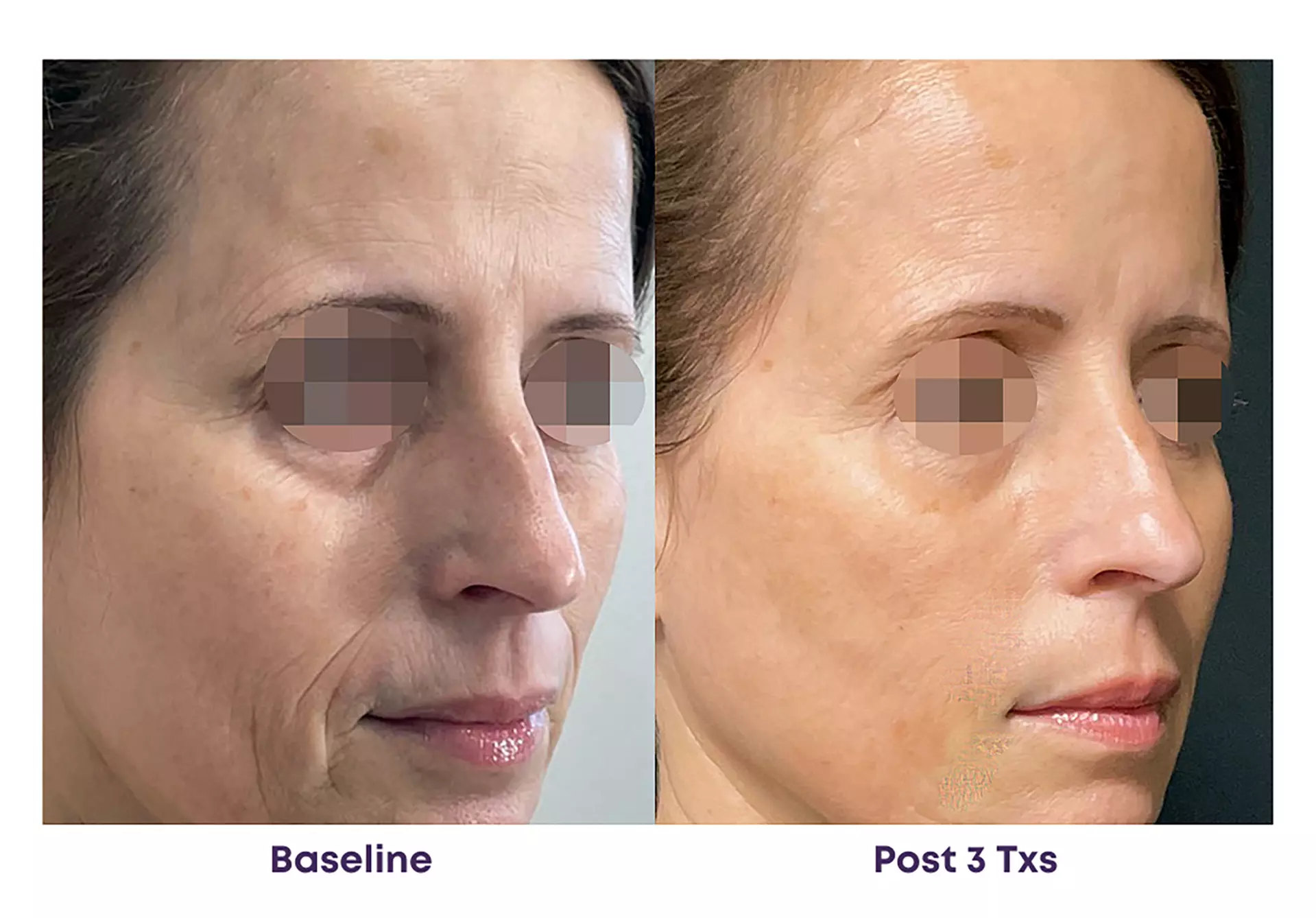 Experience Rewind Advanced Aesthetics'  Skin Tightening for Stomach, Eyes, Neck, or Knees (Up to 40% Off)