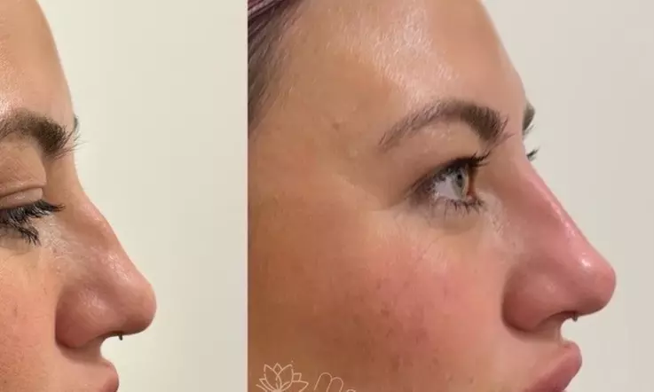 Revamp Your Look with Liquid Rhinoplasty at Modern Aesthetics & Wellness (Up to 30% Off)