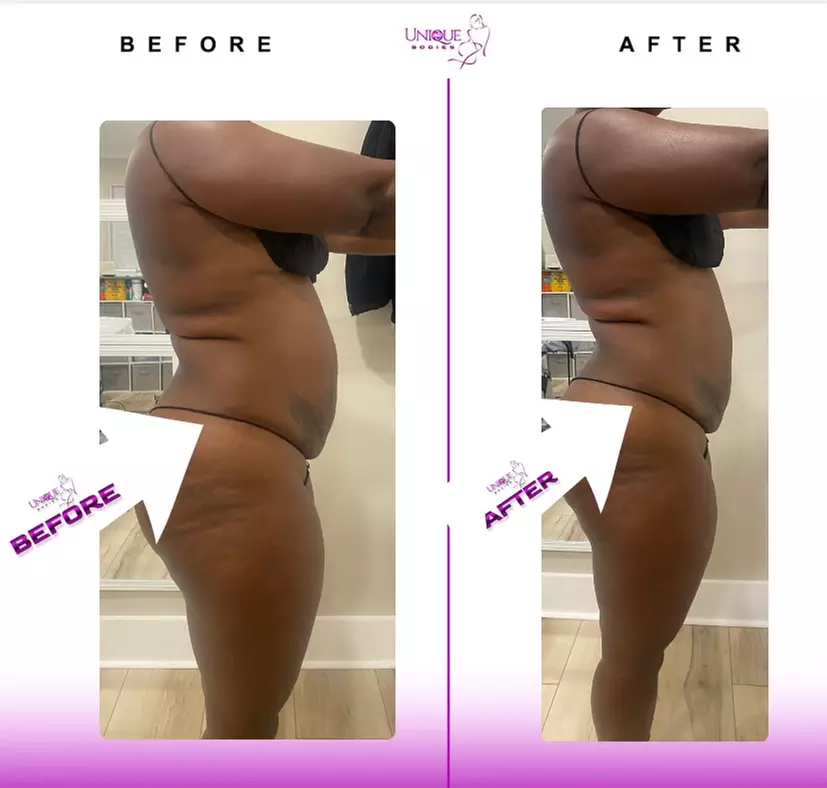 Transform your body with Four or Eight Ultrasonic-Cavitation Sessions at UnIque Bodies 360- Up to 58% Off - Primary Image