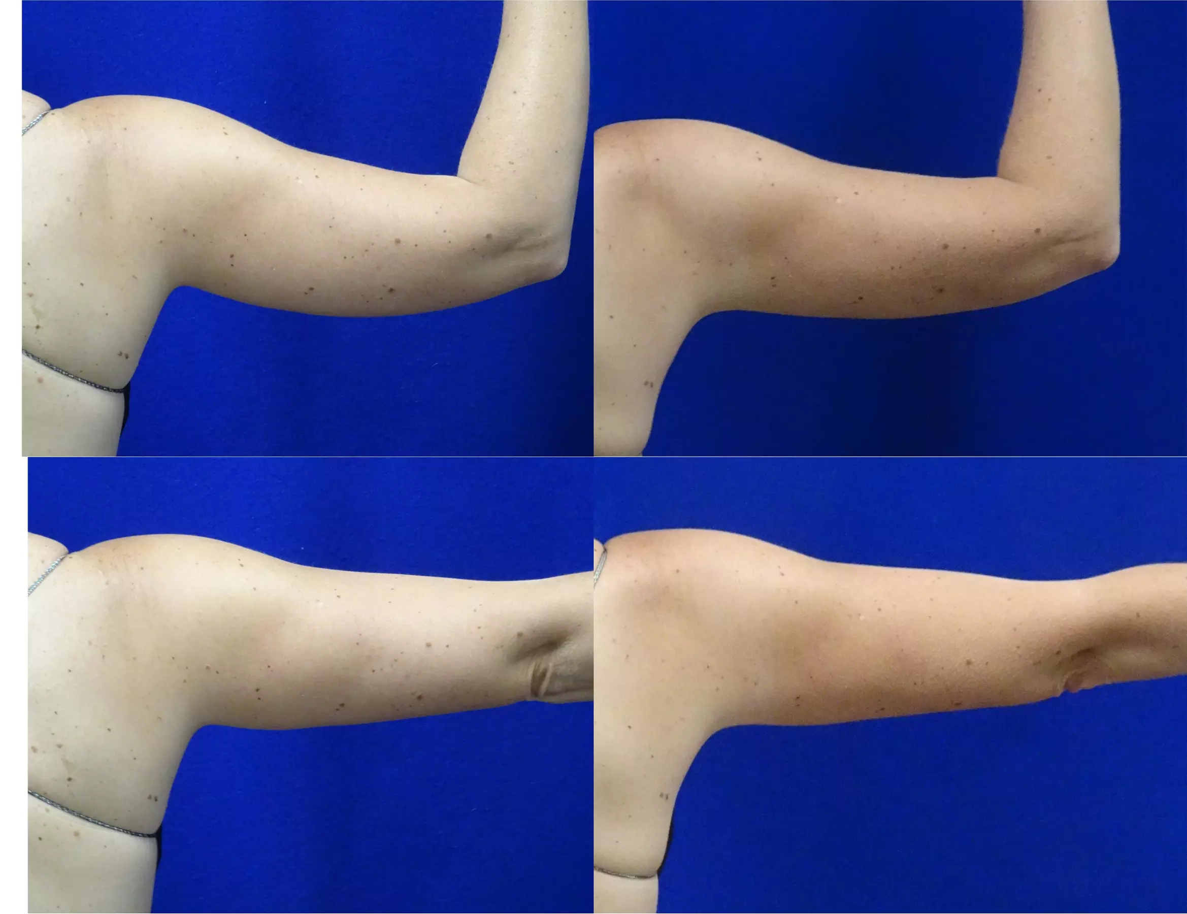 Experience Coolsculpting with a Personalized Consultation