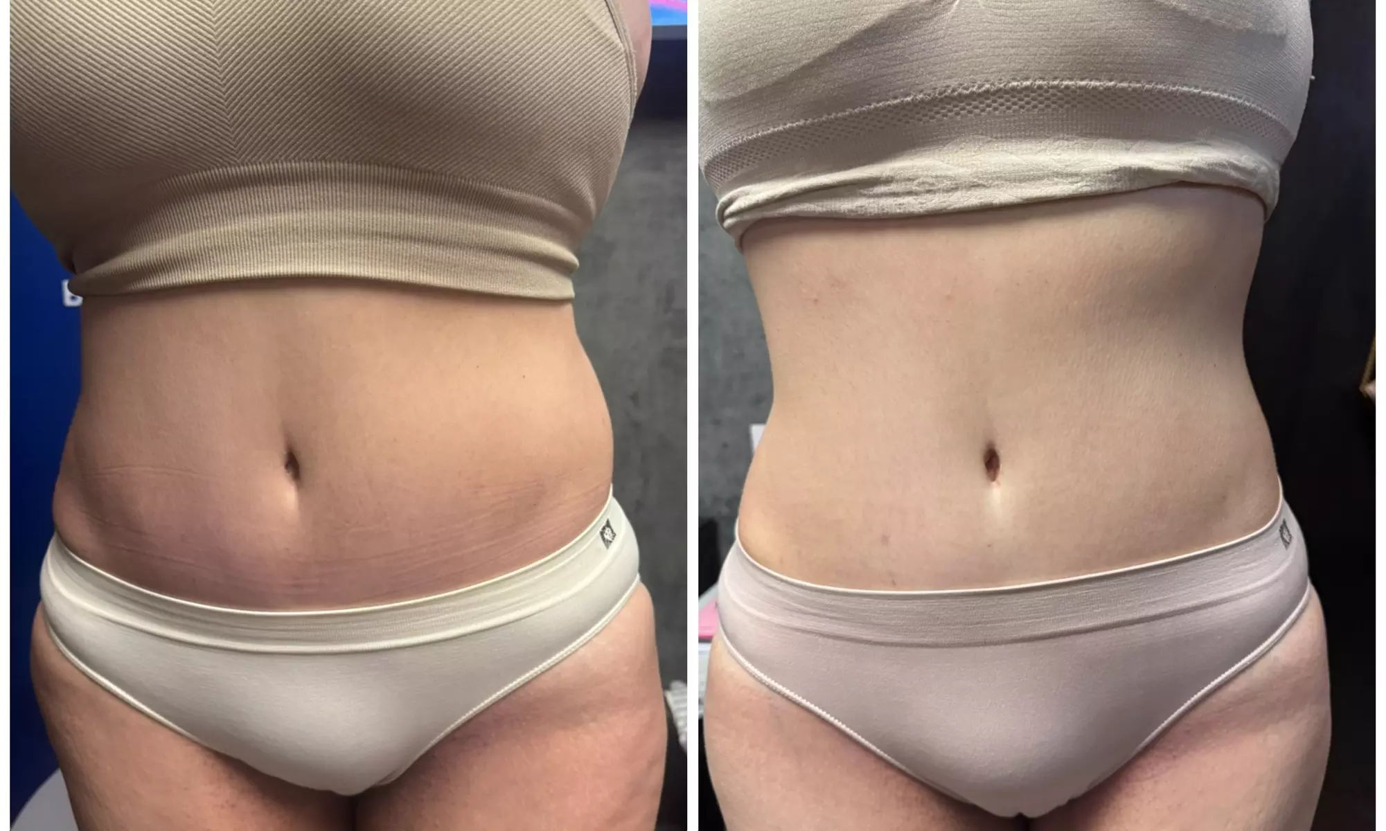 Professional Laser Lipo Body Contouring Packages (5—15 Sessions)