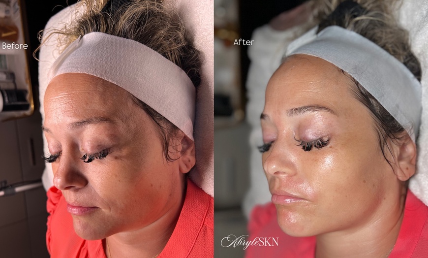 Image 4: Up to 30% Off on Facelift - Non-Surgical at AbryleSKN