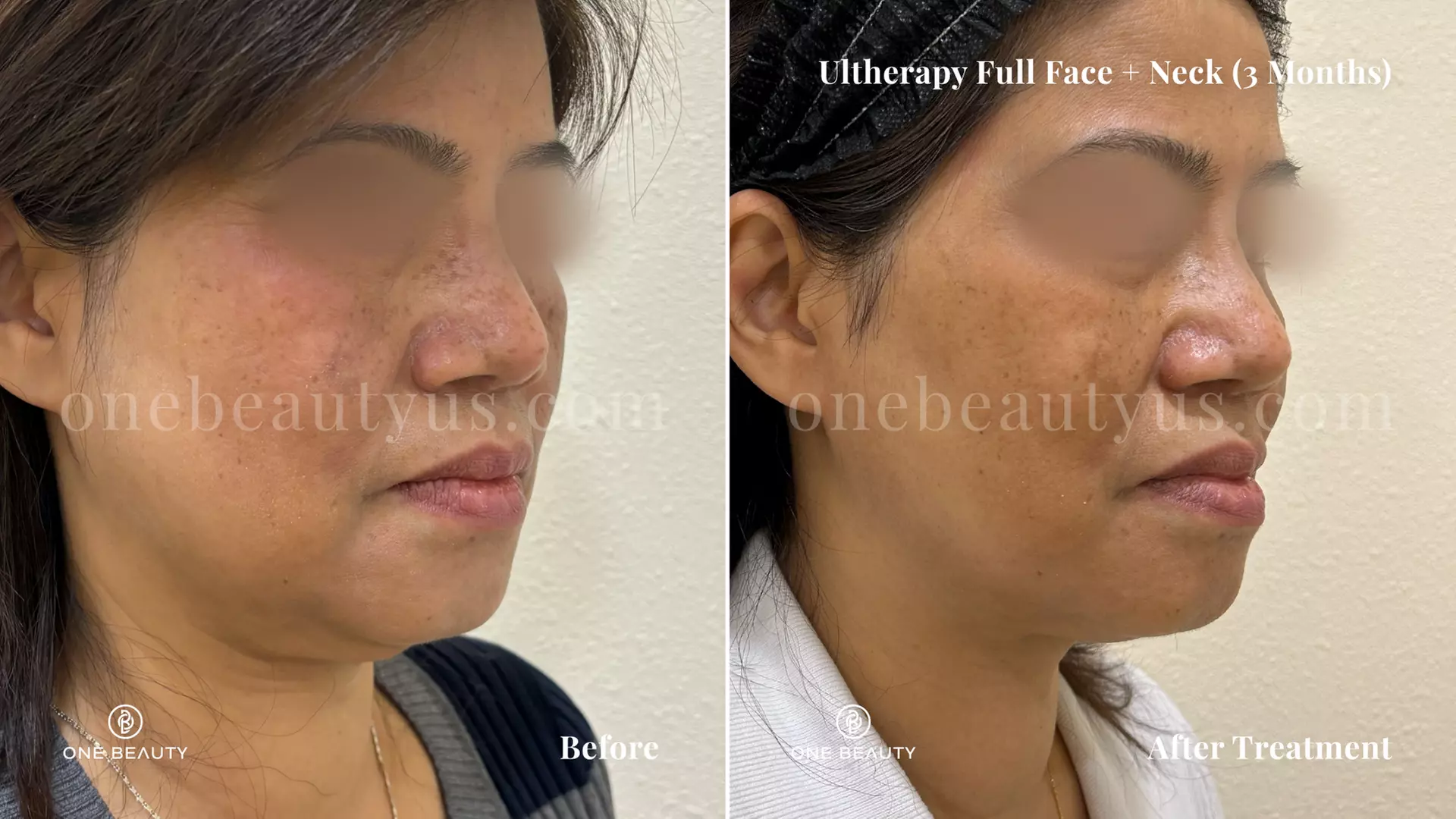 Ultherapy / Ultrasonic Facial at One Beauty Aesthetics