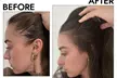 1, 2, or 3 Exosome Stem Cell or Advanced Hair Restoration Therapy with Thulium RF & Mesotherapy (Up to 40% Off) - Second Medium