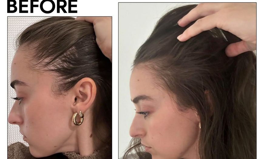 Image 3: 1, 2, or 3 Exosome Stem Cell or Hair Restoration w/ Thulium RF & More