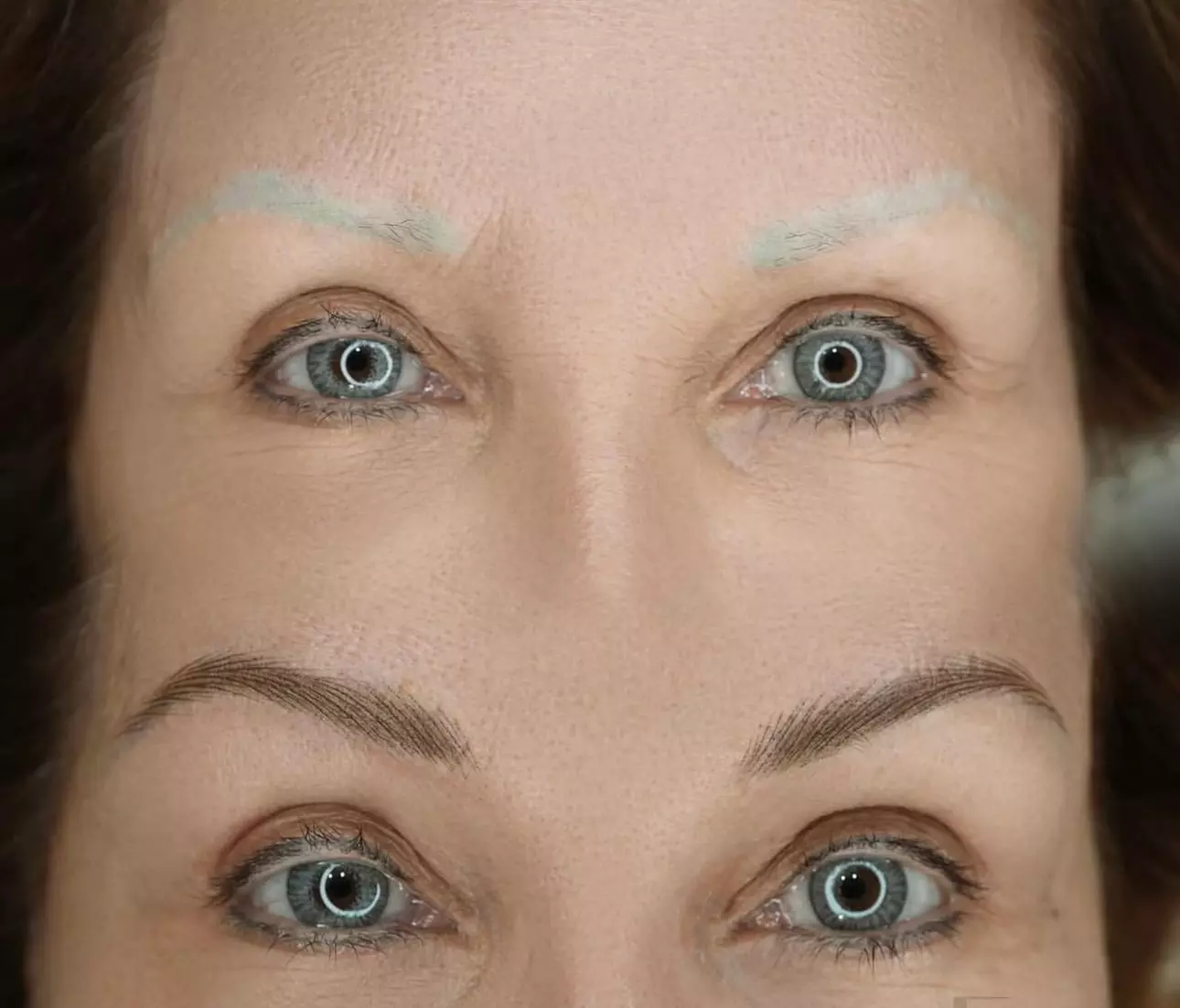 Laser Eyebrow Removal Treatments for Smooth Skin