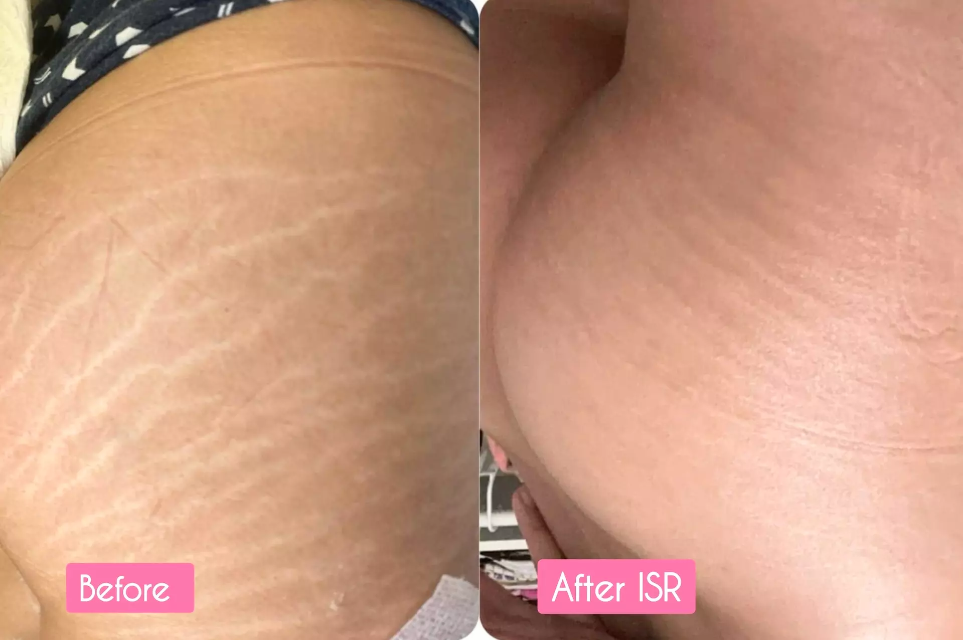 Inkless Stretch Mark Revision for All Body Sizes
