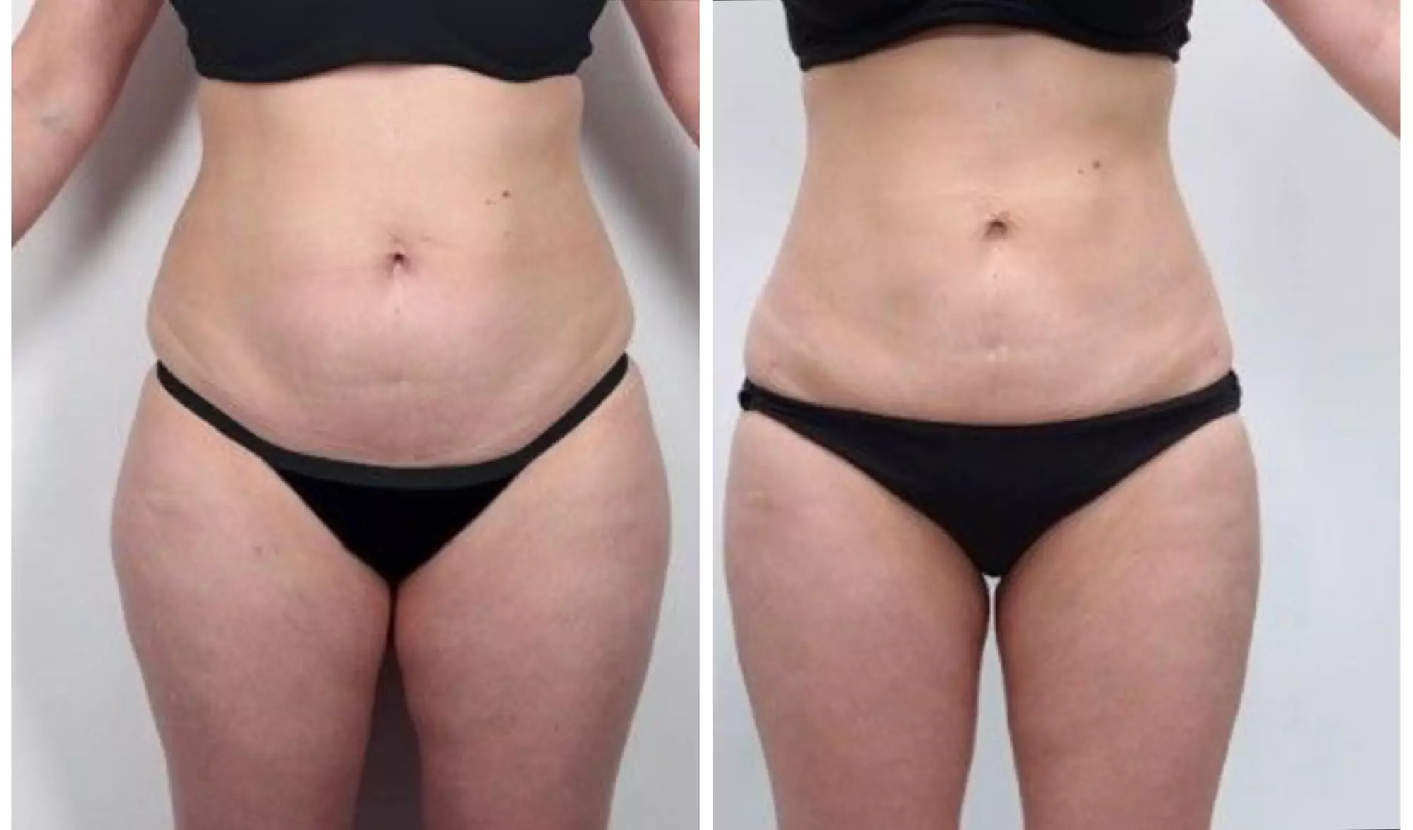 Discover EMS BOSS: 3 High intensity-focused electromagnetic Sessions for 40% Fat Loss & 50% Muscle Gain w/ up to 50% Off - Second Medium